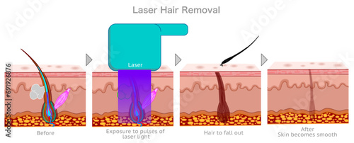 Hair removal laser epilation steps. Delete, remove, clean hair bulb depilation work stages. Permanent solution. Skin layers, anatomy, structure. Cosmetic, medical device, IPL. Illustration vector photo