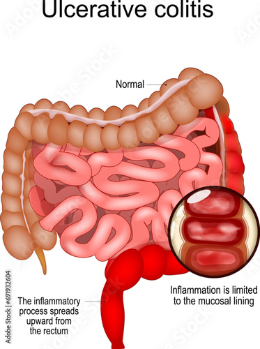 Ulcerative colitis.  inflammatory bowel disease IBD.