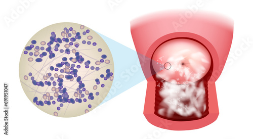 Illustration of a candidiasis infection on the cervix. Candida albicans this infection is also known as thrush (or moniliasis).Vaginal Candidiasis photo