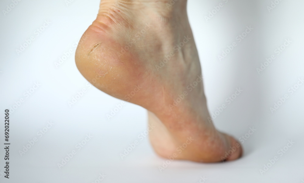 Naklejka premium Close-up of dry leg covered with painful callous. Female heel shown in modern photography studio to expose illness. Moisturizing cream advertisement concept. Isolated on white background