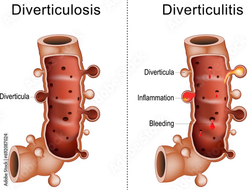 Difference between diverticulitis and diverticulosis photo