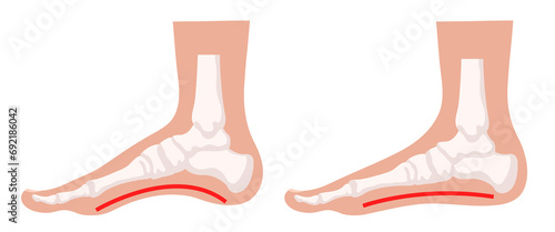 Flat feet. Normal foot and flat foot. Vector illustration.