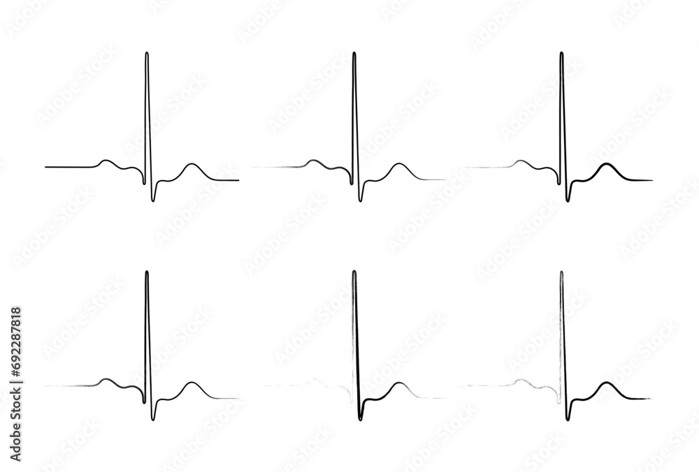 Ventricular repolarization, Cardiac cycle, ECG of heart in normal sinus rhythm, QT interval of ECG.