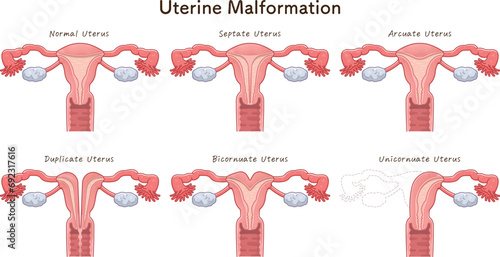 子宮奇形の種類・Uterine malformation