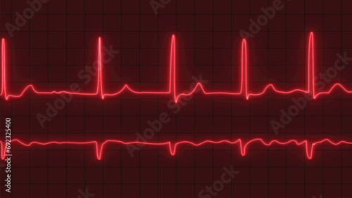 Atrial fibrillation vector. ECG or EKG pulse heartbeat red line fibrillation vector illustration. ECG with brief paroxysms of supraventricular extra systole and glowing atrial fibrillation vector.