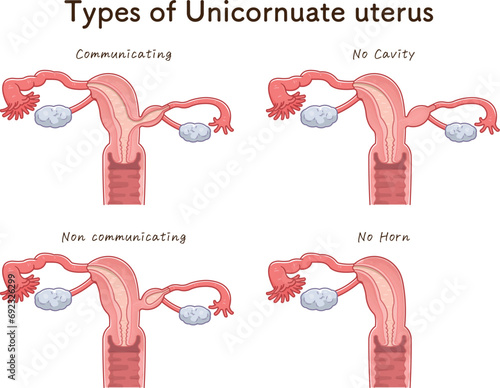 単角子宮の分類・Unicornuate uteru photo