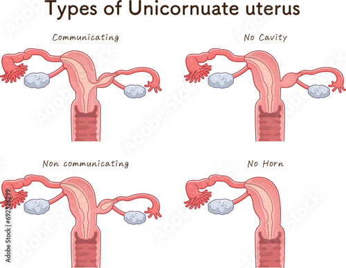 単角子宮の分類・Unicornuate uteru