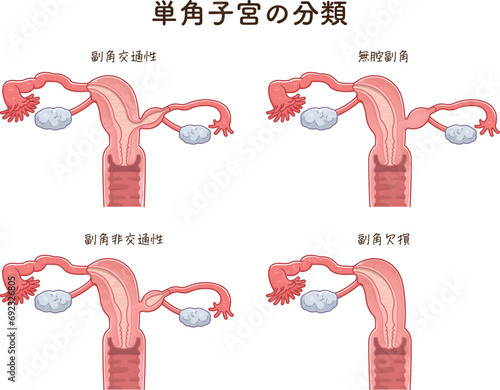 単角子宮の分類・Unicornuate uteru