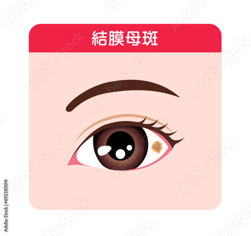 結膜母斑 (眼球拡大図) ベクターイラスト