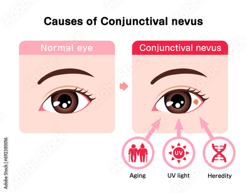 Causes of Conjunctival nevus vector illustration