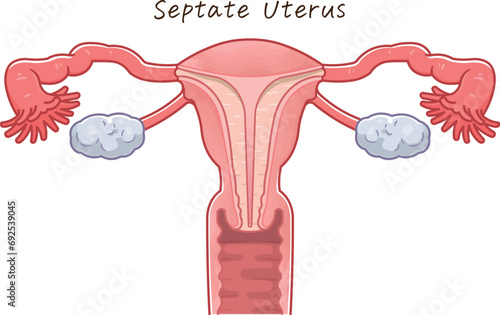 子宮奇形・Uterine malformation