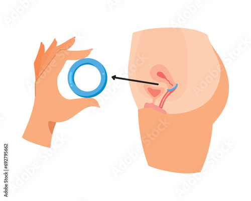 contraceptive diaphragm intrauterine