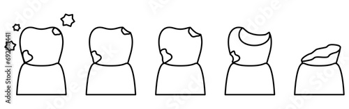 Illustration of image of cavity progression, simple line drawing