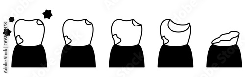 Illustration of image of cavity progression, simple line drawing