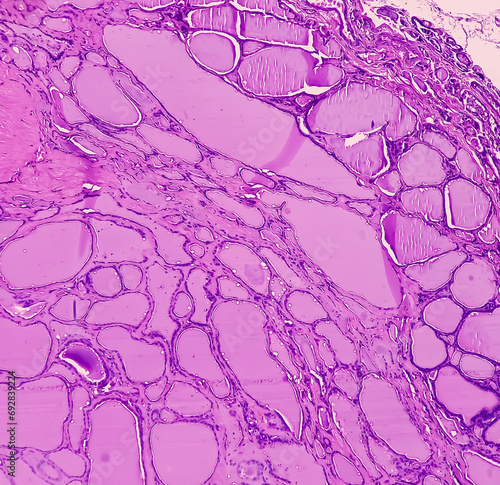 Obraz na płótnie Thyroid cancer