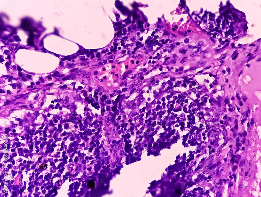 Thyroid cancer. Tracheal gland involved by tumor. Microscopic image of ...