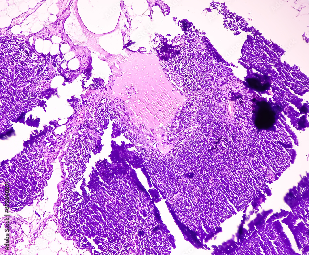 Thyroid cancer. Tracheal gland involved by tumor. Microscopic image of ...