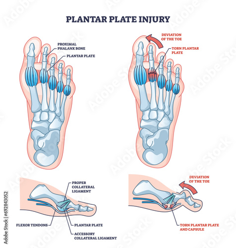 Plantar plate injury anatomy and foot capsule torn trauma outline diagram. Labeled educational scheme with skeletal foot problem and toe deviation vector illustration. Collateral ligament condition. photo