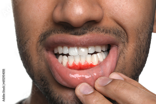 Man showing inflamed gum on white background, closeup photo
