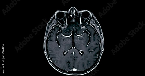 MRI Brain axial with gadolinium can help doctors look for conditions such as bleeding, swelling, tumors, infections, inflammation, damage from an injury or a stroke diseases. photo