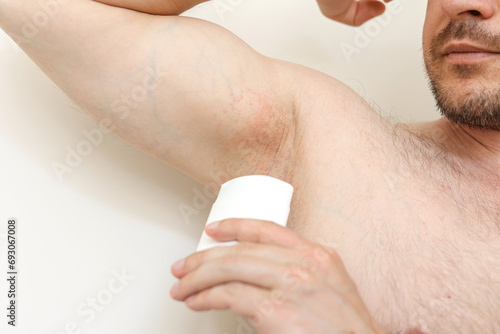 Young man with irritation, inflammation on sensitive underarm skin, using deodorant or antiperspirant for treatment armpit rash. Allergy, atopic dermatitis. Acne or red spots. Healthcare concept photo