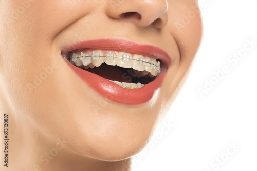 Braces. Orthodontic Treatment. Dental Care Concept. Closeup Ceramic and Metal Brackets on Teeth. Beautiful Female Smile with Braces. Beautiful Woman Healthy Smile close up on white background