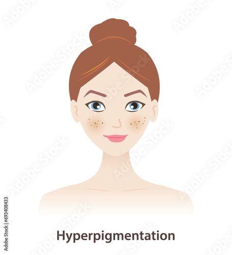 Hyperpigmentation, melasma, dark spots on woman face vector on white background. Skin pigment discoloration, darkened pigment, abnormally high amount of melanin. Skin pigment disorders concept.