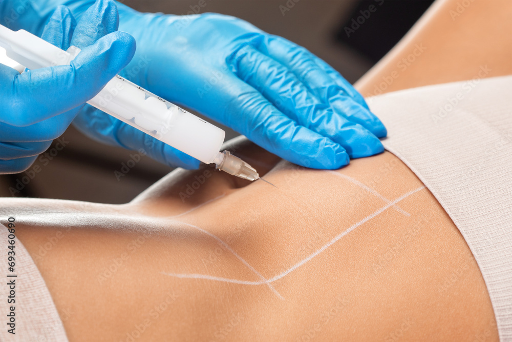 Φωτογραφία Aesthetic cosmetologist makes lipolytic injections to burn fat on the body of a woman