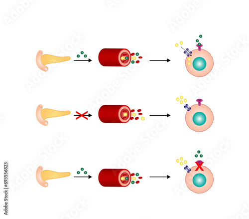 	
Diabetes mellitus type 1, pancreas's failure to produce enough insulin and type 2, cells fail to respond to insulin (Insulin resistance). Result in high blood glucose levels. Vector illustration