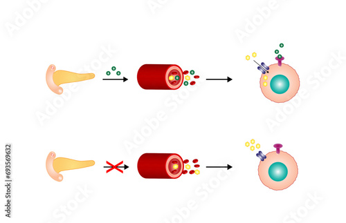 Diabetes mellitus type 1, pancreas's failure to produce enough insulin and type 2, cells fail to respond to insulin (Insulin resistance). Result in high blood glucose levels. Vector illustration