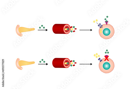 Diabetes mellitus type 2, cells fail to respond to insulin (Insulin resistance). high blood glucose levels. Vector Diagram illustration.