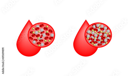 Leukemia, blood cancer. Difference between healthy normal blood and blood cancer. Blood vessel with leukocytes, erythrocytes, platelets and lymphocytes. Vector illustration.