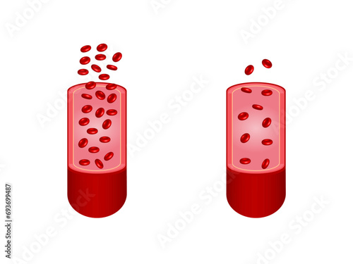 Iron deficiency anemia. The difference of Anemia amount of red blood cell and normal. Blood droplet. Blood donation. Realistic vector 3d picture. Vector illustration isolated on white background.