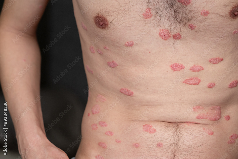 Psoriasis Vulgaris, skin patches are typically red, itchy, and scaly. Papules of chronic psoriasis vulgaris on male hand, back and body. Genetic immune disease. Detail of psoriatic skin disease Psoriasis Vulgaris, skin patches are typically red, itchy, and scaly. Papules of chronic psoriasis vulgaris on male hand, back and body. Genetic immune disease. Detail of psoriatic skin disease