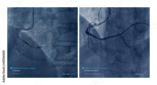 Male, 68 years old, chest pain for 7 hours. Coronary angiography suggests occlusion of the distal right coronary artery. The patient was successfully placed with a coronary stent. photo
