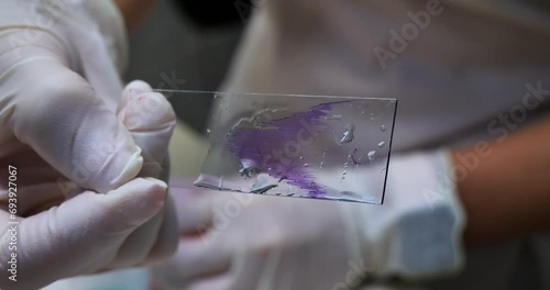 A gloved hand holds a stained blood smear. In the laboratory, a doctor holds a glass with a blood smear painted with purple paint. Blood smear prepared for microscopic examination. photo