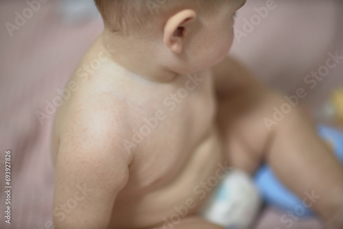 Roseola is the beginning of the course of the disease in the baby, there are barely noticeable spots on the skin rash photo