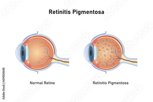 Retinitis Pigmentosa Syndrome Scientific Design. Vector Illustration.