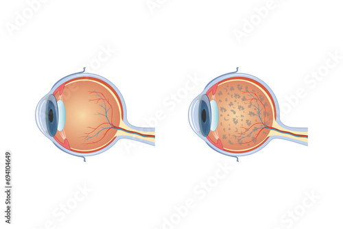 Retinitis Pigmentosa Syndrome Scientific Design. Vector Illustration.