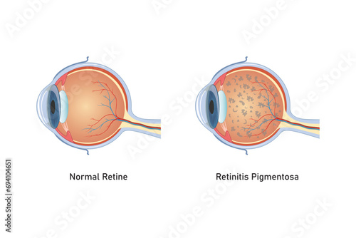 Retinitis Pigmentosa Syndrome Scientific Design. Vector Illustration.