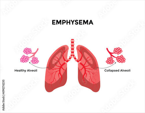Emphysema disease concept. Damaged alveoli, failure airway. Floppy walls between air sacs in human lungs.  photo