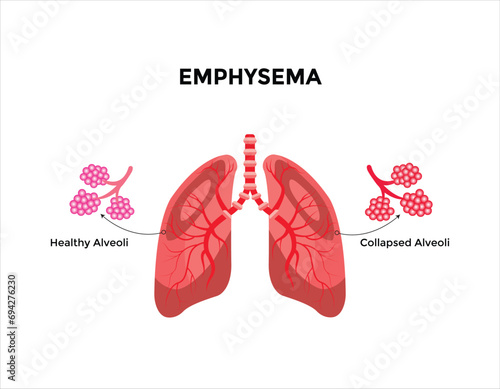 Emphysema disease concept. Damaged alveoli, failure airway. Floppy walls between air sacs in human lungs. 