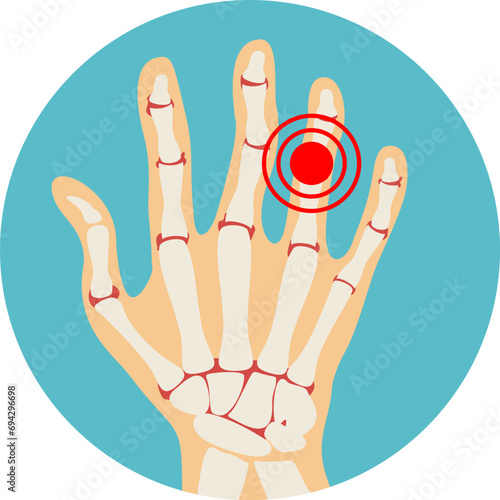 Rheumatoid polyarthritis of hands, arthritis, arthrosis. natomy of the fingers joints. Vector illustration in flat style.