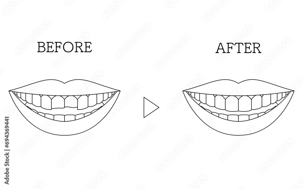 Cosmetic dentistry, direct bonding before and after, chipped tooth Cosmetic dentistry, direct bonding before and after, chipped tooth