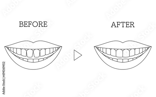 Cosmetic Dentistry, Direct Bonding Before and After, Gapped Anterior Teeth