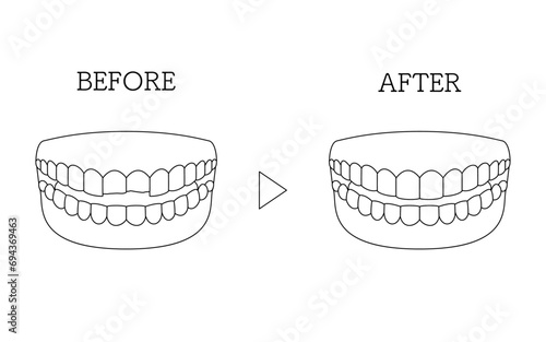 Cosmetic dentistry, direct bonding before and after, chipped tooth