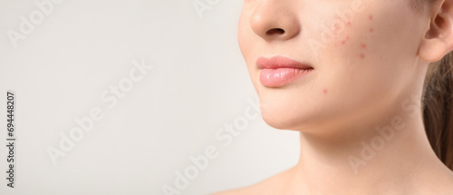Quadro su tela Young woman with acne problem on light background with space for text, closeup