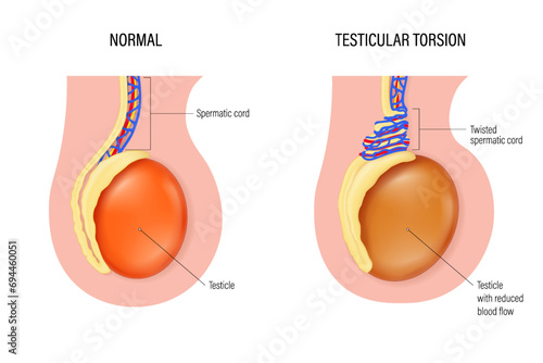 Testicular torsion vector. Comparison of normal and Testicular torsion. Testicular disease. Male reproductive system. photo