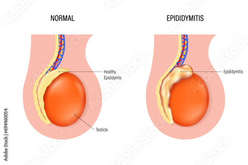 Epididymitis vector. Comparison of normal epididymis and Epididymitis. Testicular disease. Male reproductive system.
