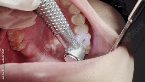 Close up shot of a dentist drilling a tooth to remove tooth cavity photo